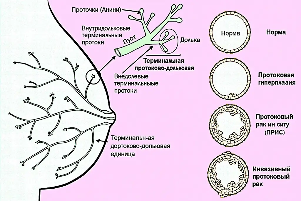 Диагностика рака молочной железы