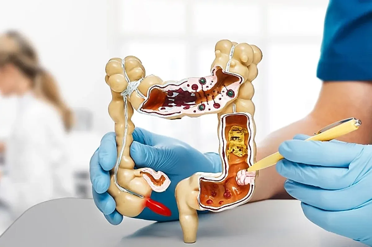 Профилактика рака кишечника