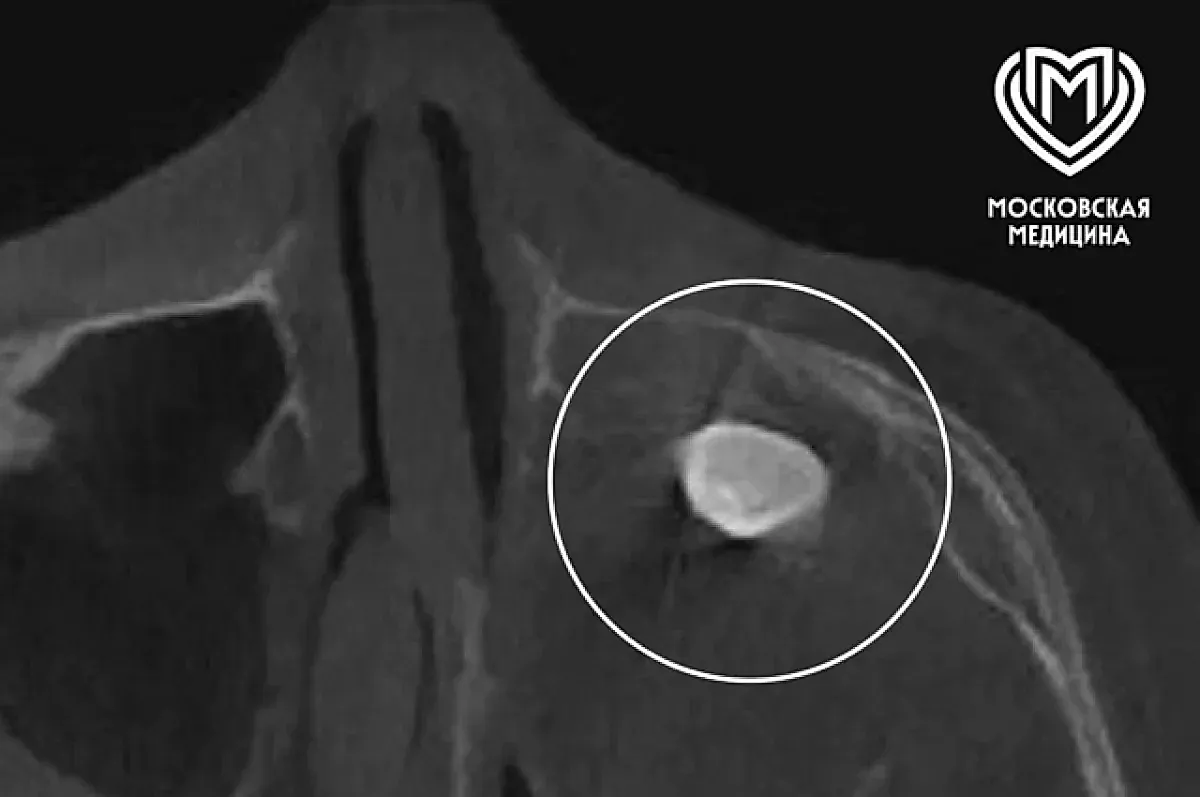 Удаление зуба из носа у подростка в Филатовской больнице