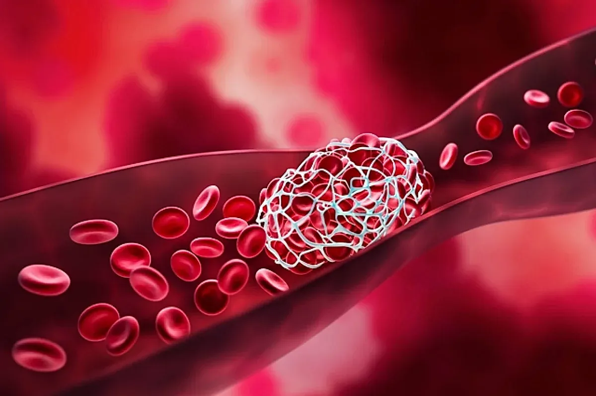 Инсульт у молодых