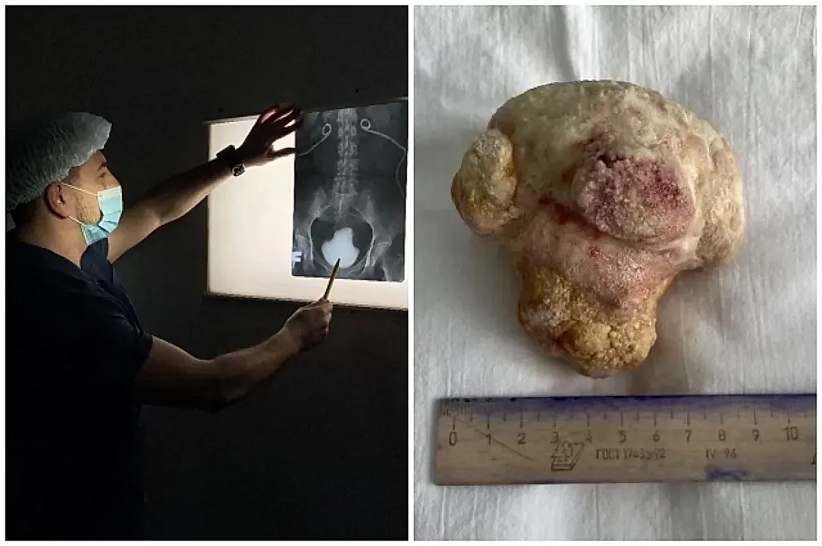 История удаления крупного камня из мочевого пузыря у женщины