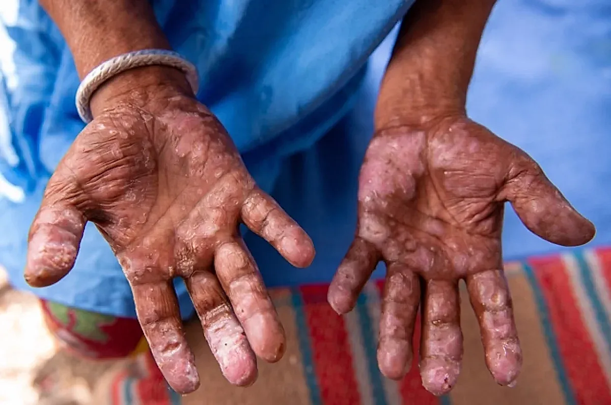 Проказа и риск завоза в Россию