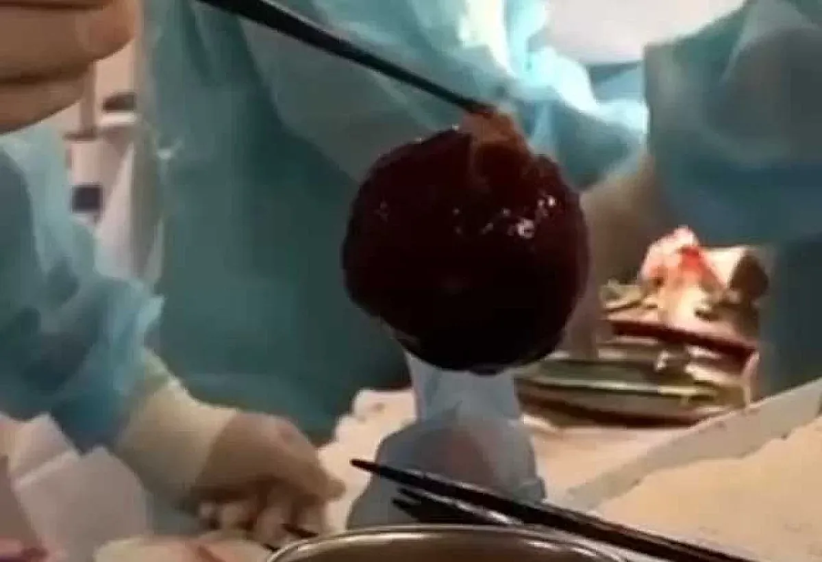 Опухоль в сердце спасена операцией