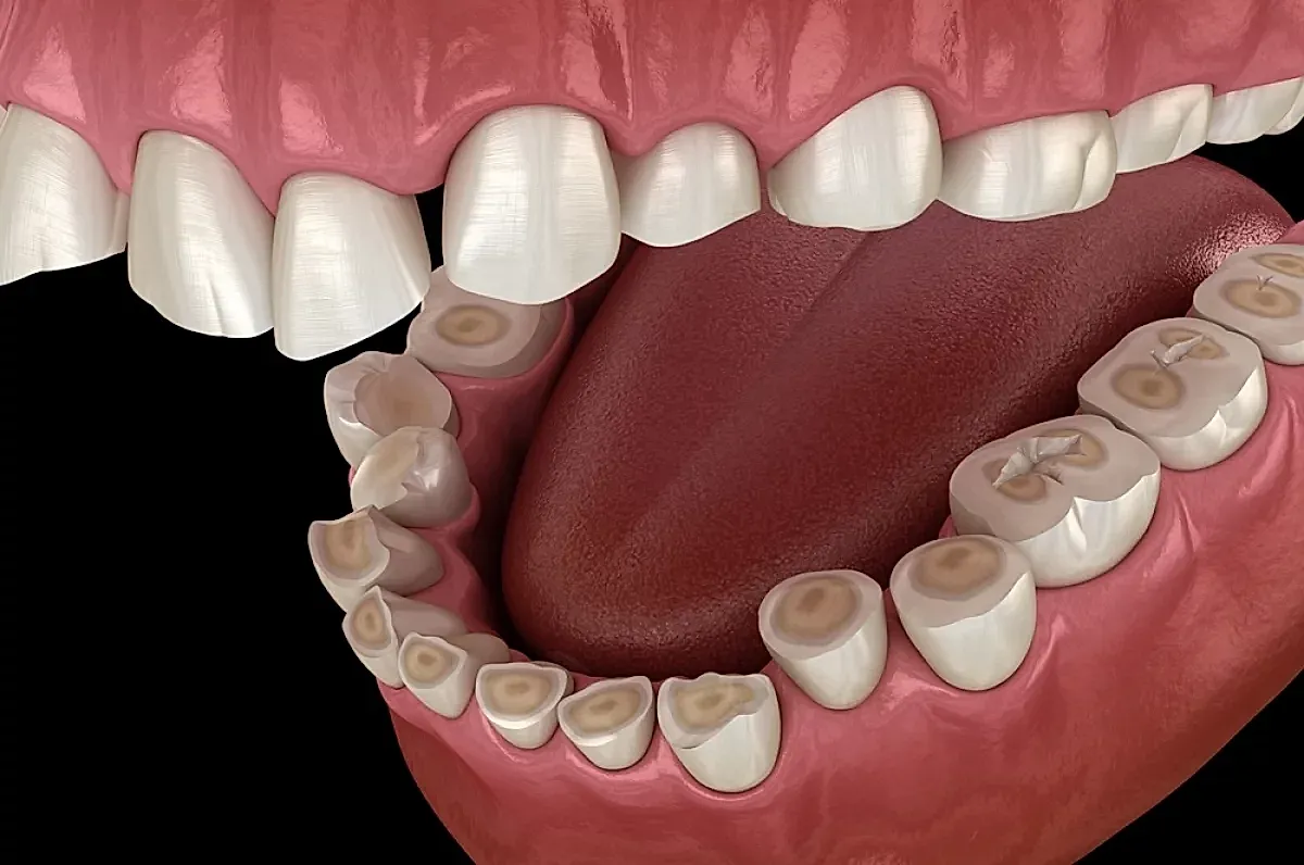 Ночная привычка и разрушение эмали зубов