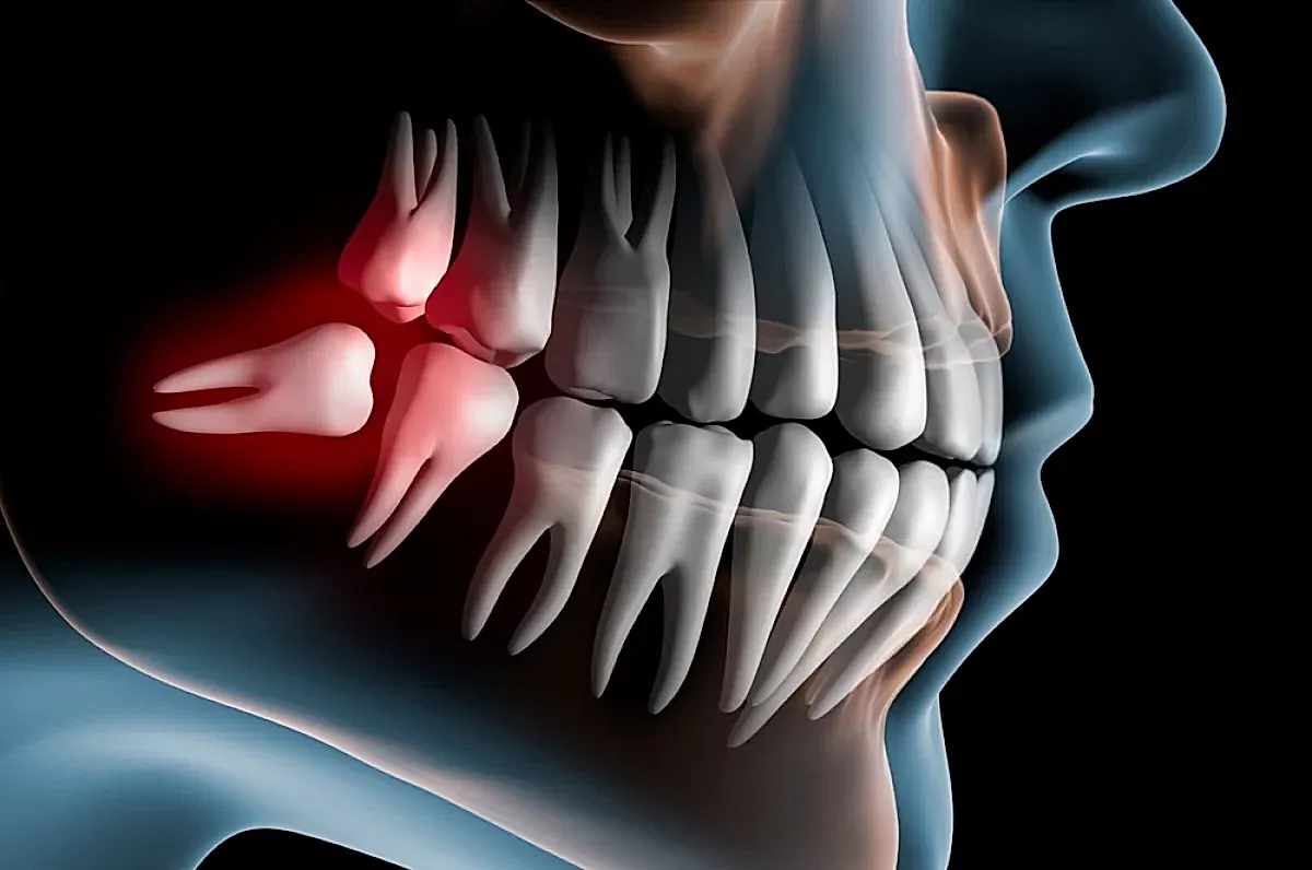 Зубы мудрости — сохранить или удалить