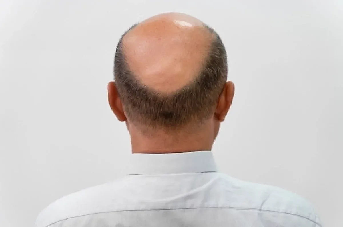 Мифы о выпадении волос от трихолога Галлямовой