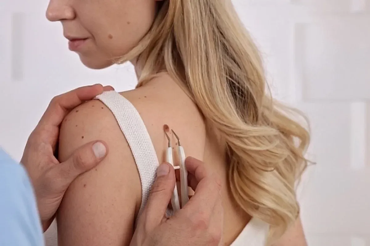 Риски меланомы после повреждения родинки