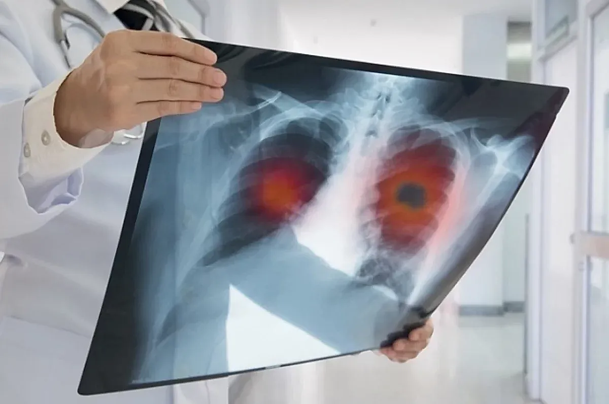 Боль в плече и рак лёгких