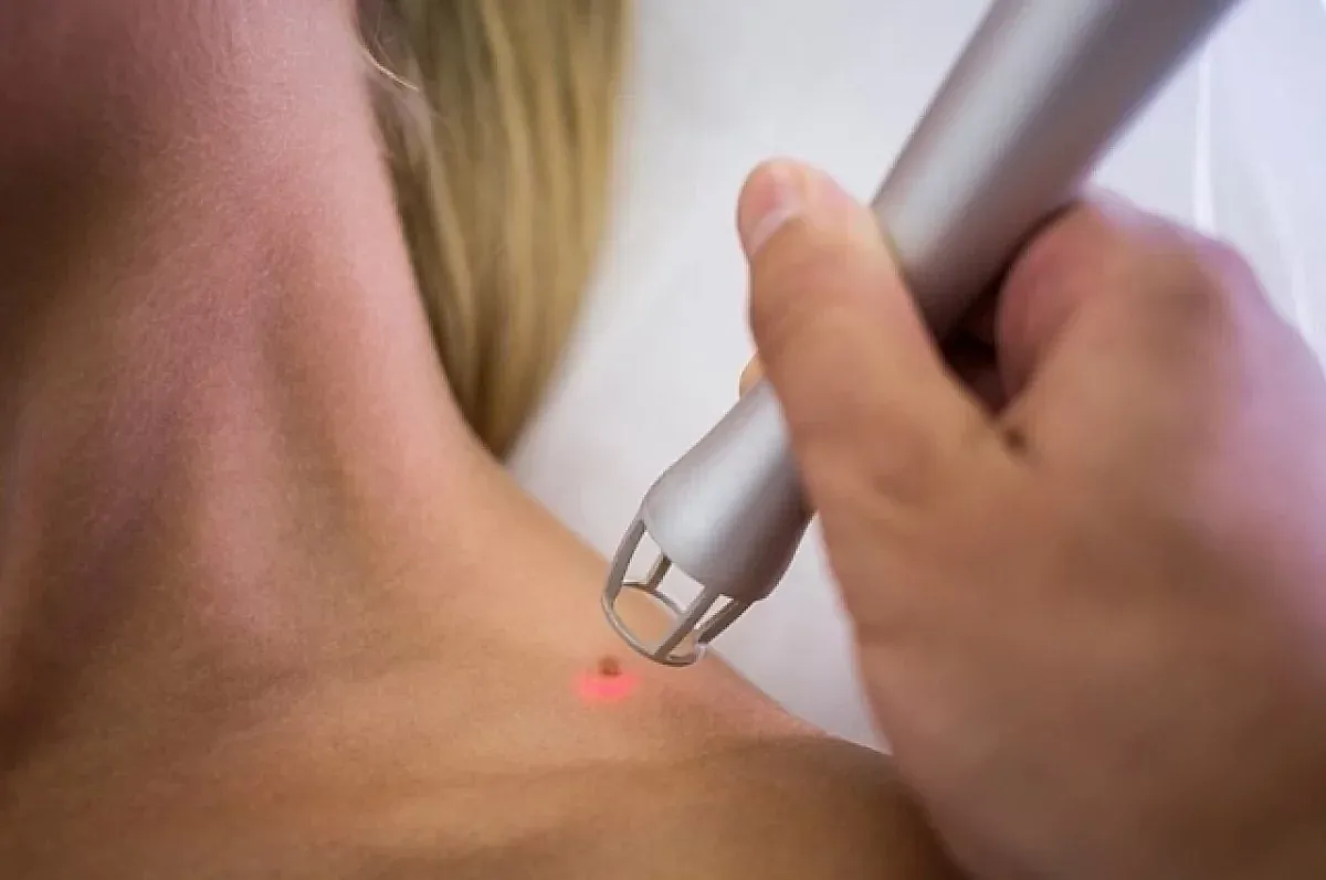 Меланома и солярий: предупреждение